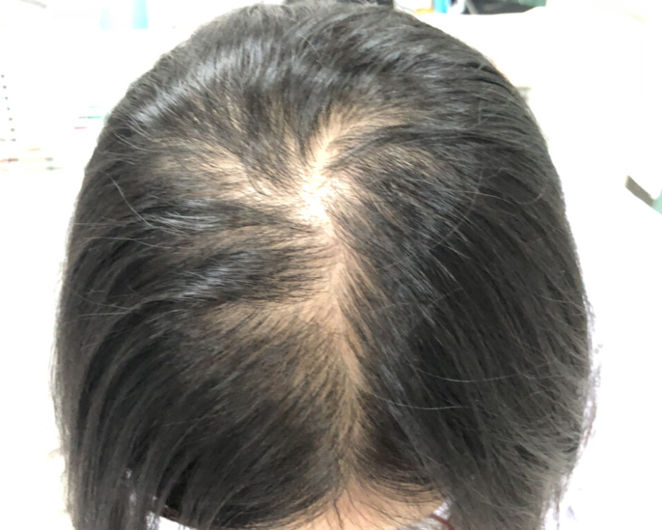 厦门看脱发医院哪家比较好,脱发预防方法有哪些【厦门广肤皮肤病专科医院】